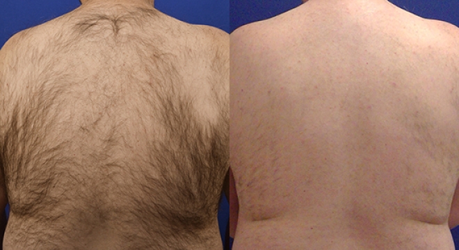 Lightsheer Treatment